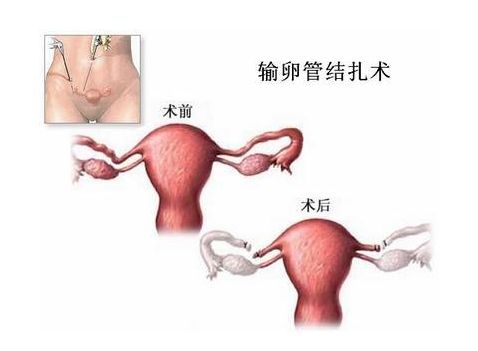 代孕